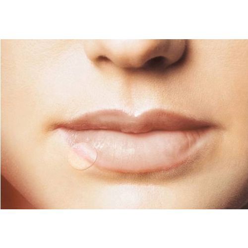 HERPES PATCH bei Lippenherpes 15 mm